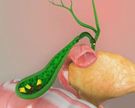 gall1